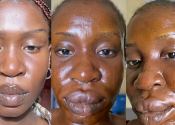 A Nigerian Lady shows off her allergic face she gets  after eating catfish