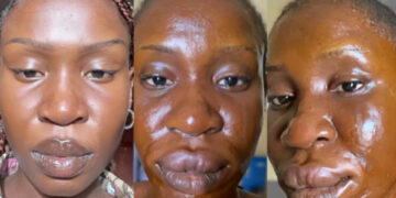 A Nigerian Lady shows off her allergic face she gets  after eating catfish