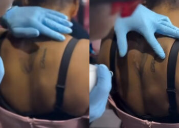 Lady Seen Removing Tattoo Of Her ex-Boyfriend After Their Relationship Ended 