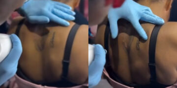 Lady Seen Removing Tattoo Of Her ex-Boyfriend After Their Relationship Ended 