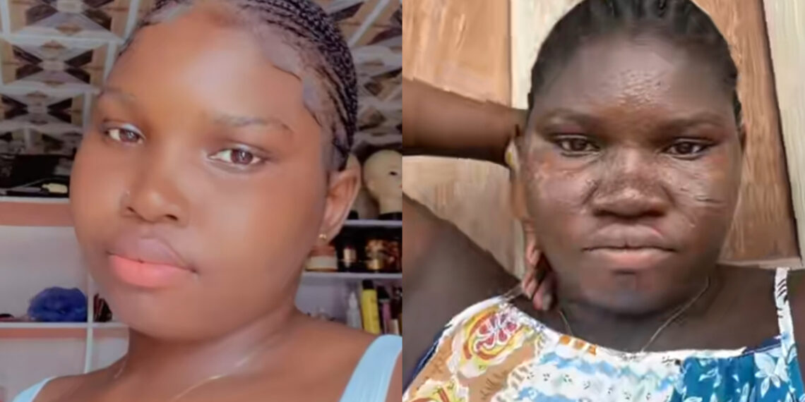 Shocking Transformation: Nigerian Woman Reveals Before And During Pregnancy Skin Changes