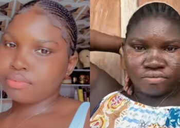 Shocking Transformation: Nigerian Woman Reveals Before And During Pregnancy Skin Changes
