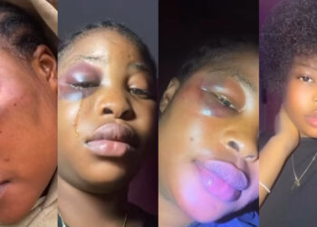 Lady Shows photos of Face That Was Being Redesigned by Lovely Boyfriend 
