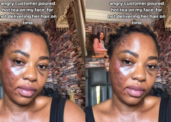 “Life didn’t end when an angry customer poured hot tea on my face for not delivering her hair on time” Lady recaps how customer poured her hot tea on her face and she survive it