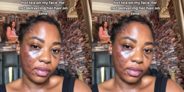 “Life didn’t end when an angry customer poured hot tea on my face for not delivering her hair on time” Lady recaps how customer poured her hot tea on her face and she survive it