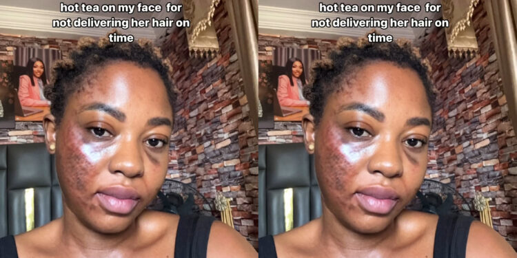 “Life didn’t end when an angry customer poured hot tea on my face for not delivering her hair on time” Lady recaps how customer poured her hot tea on her face and she survive it