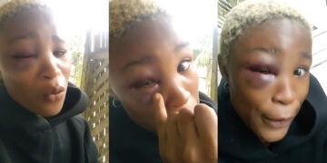 “hold your baby tight, Who you wan leave am for?” hilarious reactions trailing as Nigerian lady cries out and seeks for Justice after her Boyfriend Redesigned her one eye