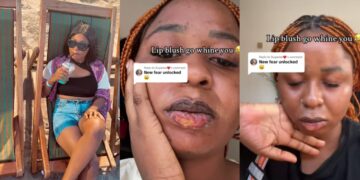 Woman Draws Attention by Sharing Results of Lip Blush Procedure.