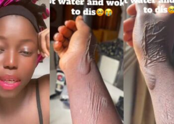 “Life is spiritual”- Woman wakes up to mysterious burns on her hand after dreaming of dipping it in hot water