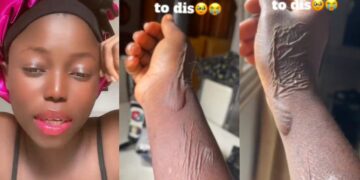 “Life is spiritual”- Woman wakes up to mysterious burns on her hand after dreaming of dipping it in hot water